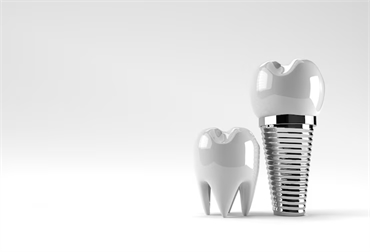 How to Care for Your Dental Implants for Maximum Success