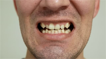 Worn Teeth Causes Consequences and Solutions in Vancouver
